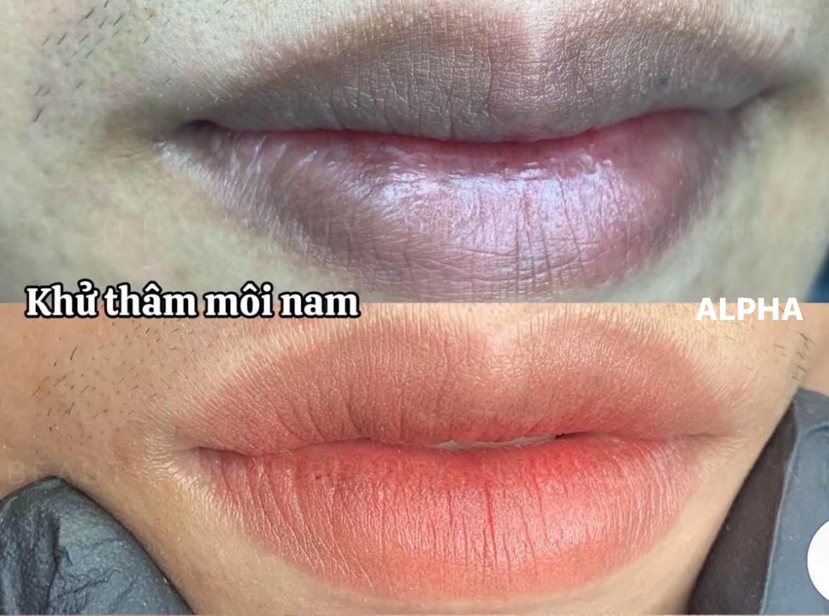 Khử thâm môi nam trước và sau tại Alpha Brows